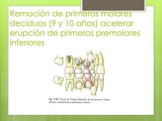 Remoción de primeros molares
deciduos (9 y 10 años) acelerar
erupción de primeros premolares
inferiores
 