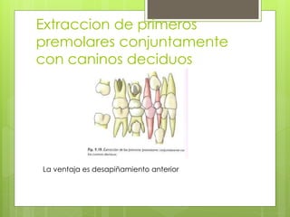 Extraccion de primeros
premolares conjuntamente
con caninos deciduos
La ventaja es desapiñamiento anterior
 