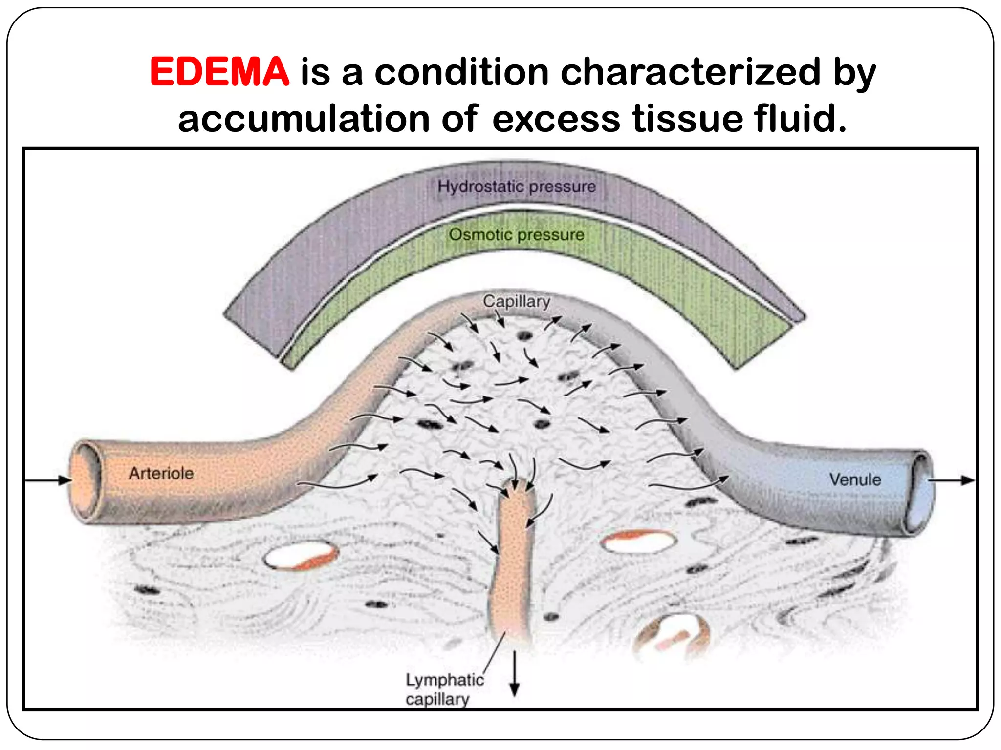EDEMA is a condition characterized by
 accumulation of excess tissue fluid.
 