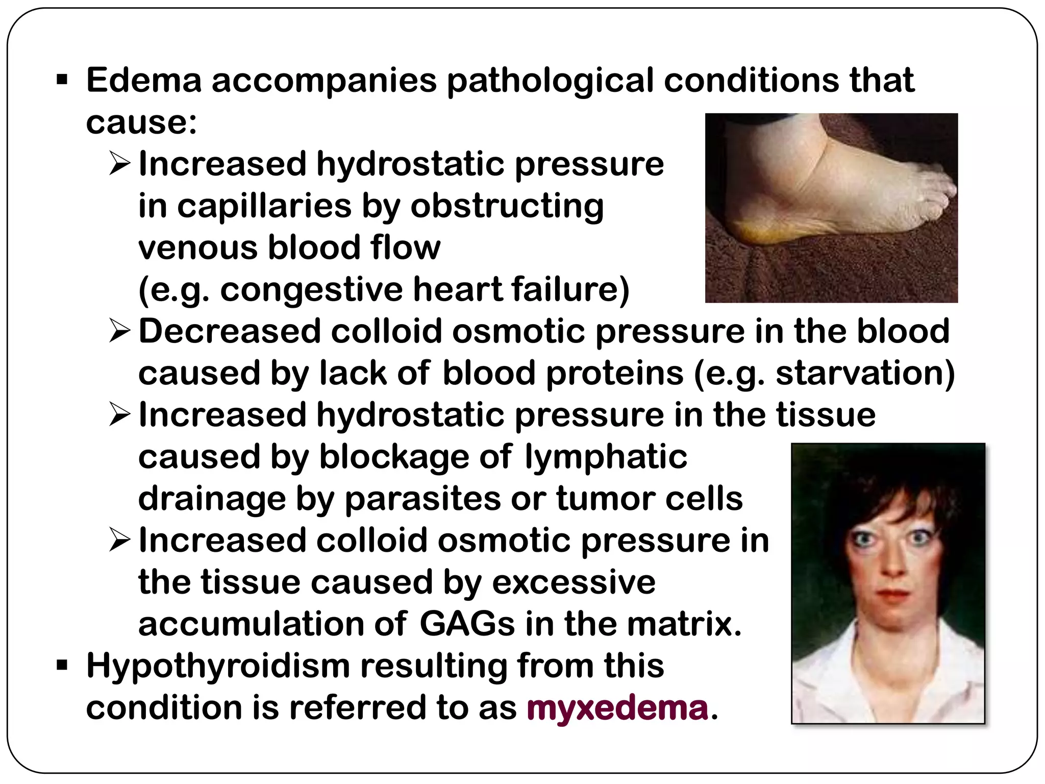  Edema accompanies pathological conditions that
  cause:
    Increased hydrostatic pressure
     in capillaries by obstructing
     venous blood flow
     (e.g. congestive heart failure)
    Decreased colloid osmotic pressure in the blood
     caused by lack of blood proteins (e.g. starvation)
    Increased hydrostatic pressure in the tissue
     caused by blockage of lymphatic
     drainage by parasites or tumor cells
    Increased colloid osmotic pressure in
     the tissue caused by excessive
     accumulation of GAGs in the matrix.
 Hypothyroidism resulting from this
  condition is referred to as myxedema.
 