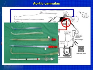 Aortic cannulas
 