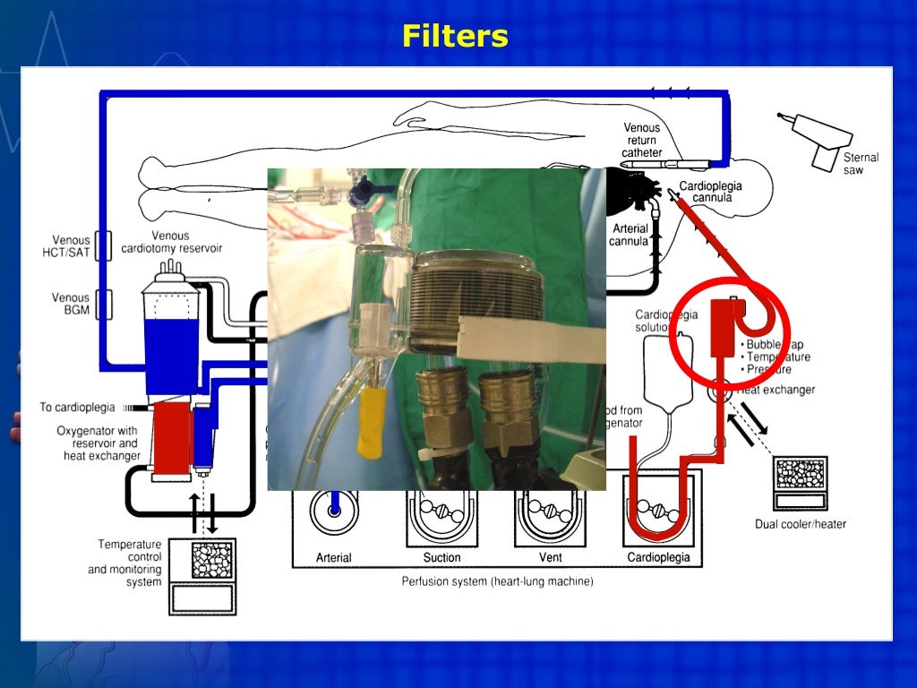 Extracorporeal circulation CPB, ECMO