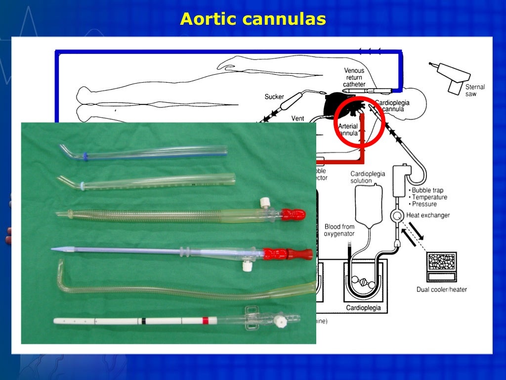 Extracorporeal circulation CPB, ECMO