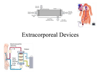 Extracorporeal Devices
 