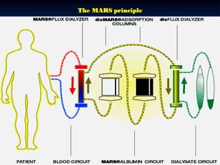Extracorporeal liver support therapies | PDF