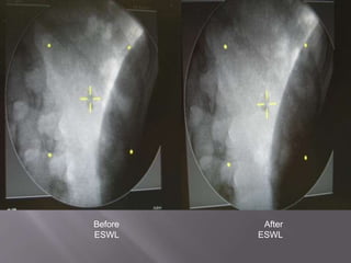 Extracorporeal shock wave lithotripsy (eswl) | PPTX