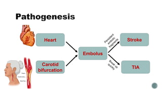 Ecvd Extracranial Cerebrovascular Disease | PDF