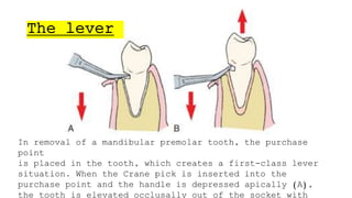 Simple Routine Extraction Routine Exodontia - simple extraction | PPTX