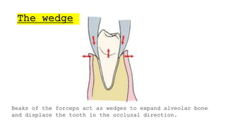 Simple Routine Extraction Routine Exodontia - simple extraction | PPTX