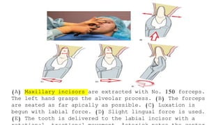 Simple Routine Extraction Routine Exodontia - simple extraction | PPTX