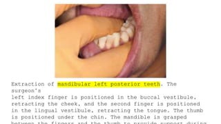 Simple Routine Extraction Routine Exodontia - simple extraction | PPTX