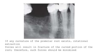 Simple Routine Extraction Routine Exodontia - simple extraction | PPTX