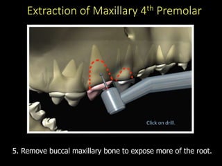 Extraction of Maxillary 4th Premolar
5. Remove buccal maxillary bone to expose more of the root.
Click on drill.
 