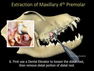 Extraction of Maxillary 4th Premolar
6. First use a Dental Elevator to loosen the distal root,
then remove distal portion of distal root
Click on elevator.
 