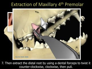 Extraction of Maxillary 4th Premolar
7. Then extract the distal root by using a dental forceps to twist it
counter-clockwise, clockwise, then pull.
Click in box
Go to next slide
 