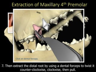 Extraction of Maxillary 4th Premolar
7. Then extract the distal root by using a dental forceps to twist it
counter-clockwise, clockwise, then pull.
Click on dental forceps.
 
