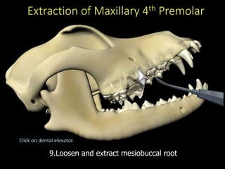 Extraction of Maxillary 4th Premolar
9.Loosen and extract mesiobuccal root
Click on dental elevator.
 