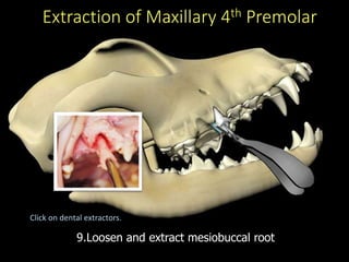Extraction of Maxillary 4th Premolar
9.Loosen and extract mesiobuccal root
Click on dental extractors.
 