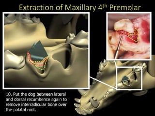 Extraction of Maxillary 4th Premolar
10. Put the dog between lateral
and dorsal recumbence again to
remove interradicular bone over
the palatal root.
 