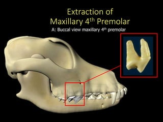Extraction of
Maxillary 4th Premolar
D
A: Buccal view maxillary 4th premolar
 