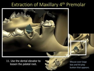 Extraction of Maxillary 4th Premolar
11. Use the dental elevator to
loosen the palatal root.
Mouse-over large
box and hit play
button that appears.
 