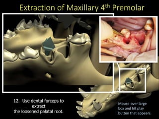Extraction of Maxillary 4th Premolar
12. Use dental forceps to
extract
the loosened palatal root.
Mouse-over large
box and hit play
button that appears.
 
