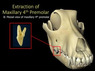 Extraction of
Maxillary 4th Premolar
D
B: Mesial view of maxillary 4th premolar
 