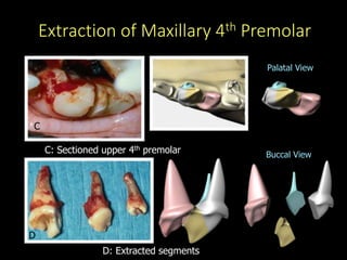 C
D
D: Extracted segments
C: Sectioned upper 4th premolar
Extraction of Maxillary 4th Premolar
Palatal View
Buccal View
 