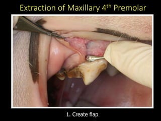 Extraction of Maxillary 4th Premolar
1. Create flap
 
