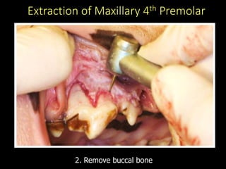 Extraction of Maxillary 4th Premolar
2. Remove buccal bone
 