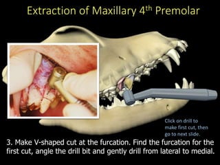 Extraction of Maxillary 4th Premolar
3. Make V-shaped cut at the furcation. Find the furcation for the
first cut, angle the drill bit and gently drill from lateral to medial.
Click on drill to
make first cut, then
go to next slide.
 