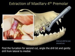 Extraction of Maxillary 4th Premolar
Find the furcation for second cut, angle the drill bit and gently
drill from lateral to medial.
Click on drill to see
second cut.
 