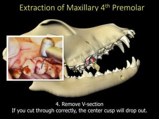 Extraction of Maxillary 4th Premolar
4. Remove V-section
If you cut through correctly, the center cusp will drop out.
 
