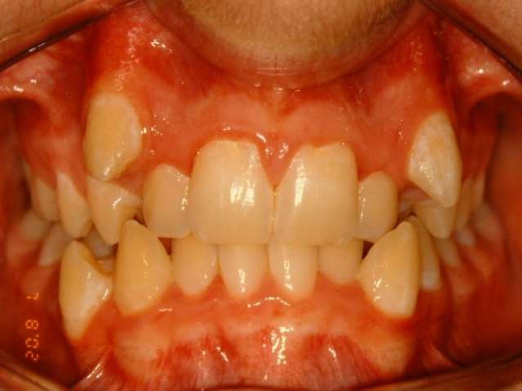 Extraction in orthodontic