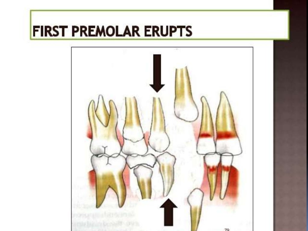Extraction in orthodontic