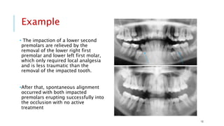 • The impaction of a lower second
premolars are relieved by the
removal of the lower right first
premolar and lower left first molar,
which only required local analgesia
and is less traumatic than the
removal of the impacted tooth.
•After that, spontaneous alignment
occurred with both impacted
premolars erupting successfully into
the occlusion with no active
treatment
Example
12
 