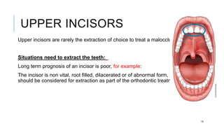 UPPER INCISORS
Upper incisors are rarely the extraction of choice to treat a malocclusion.
Situations need to extract the teeth:
Long term prognosis of an incisor is poor, for example:
The incisor is non vital, root filled, dilacerated or of abnormal form, the tooth
should be considered for extraction as part of the orthodontic treatment plan
19
 