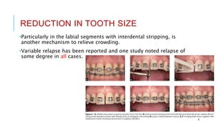REDUCTION IN TOOTH SIZE
•Particularly in the labial segments with interdental stripping, is
another mechanism to relieve crowding.
•Variable relapse has been reported and one study noted relapse of
some degree in all cases.
6
 