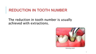 REDUCTION IN TOOTH NUMBER
The reduction in tooth number is usually
achieved with extractions.
7
 