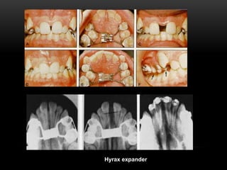 Extraction of teeth as part of orthodontics | PPTX