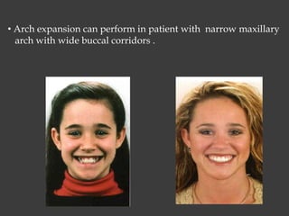 • Arch expansion can perform in patient with narrow maxillary
arch with wide buccal corridors .
 