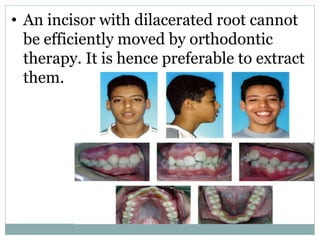 • An incisor with dilacerated root cannot
be efficiently moved by orthodontic
therapy. It is hence preferable to extract
them.
 
