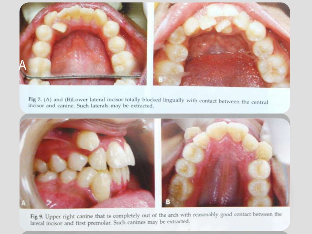 Extractions in orthodontics ug Extractions in orthodontics ug