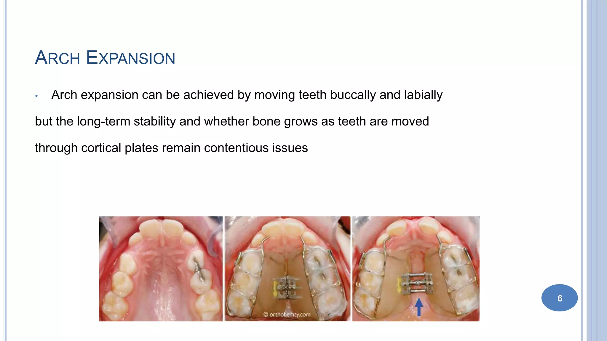Extractions in Orthodontics Journal Club Presentation | PPTX