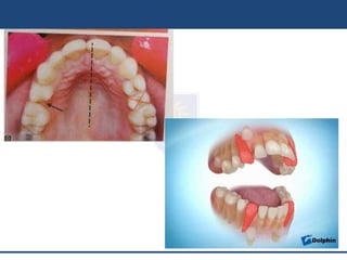 Extractions | PPT