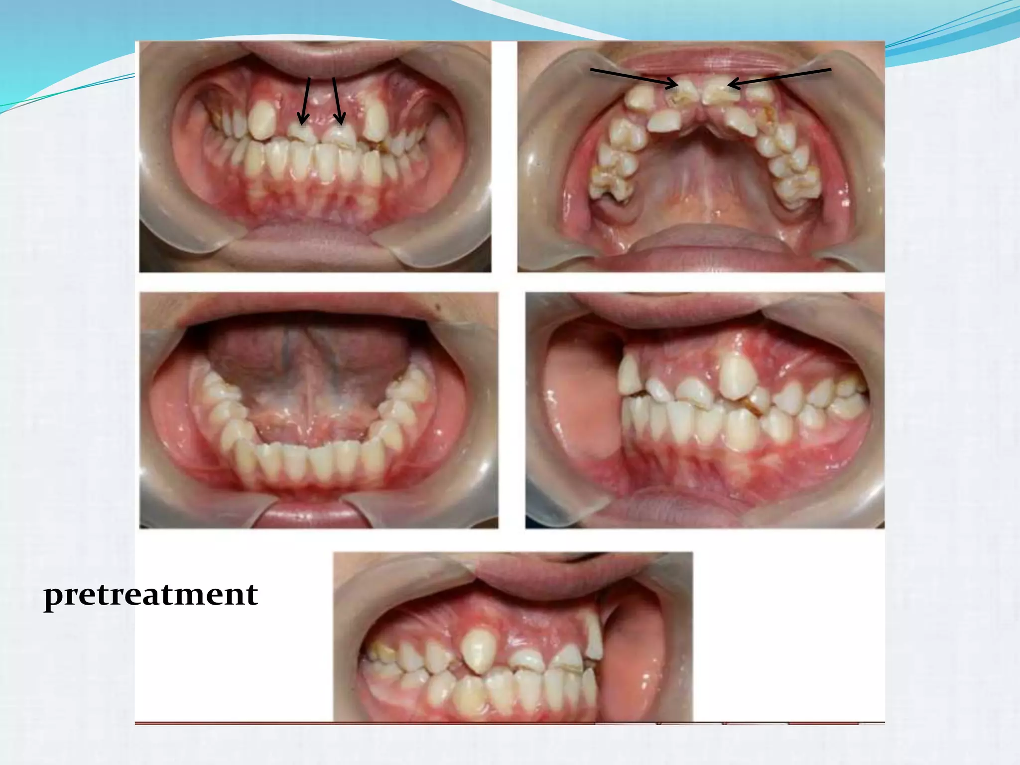 Extraction teeth for gaining space in orthodontics | PPTX