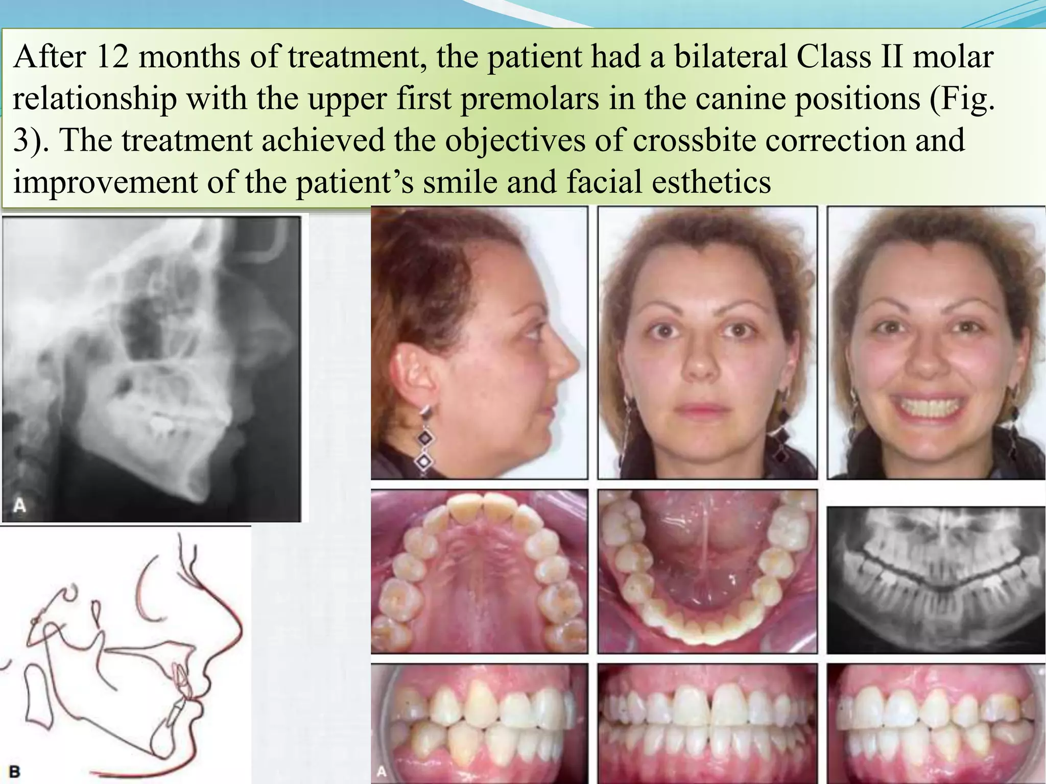Extraction teeth for gaining space in orthodontics | PPTX