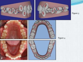 Extraction teeth for gaining space in orthodontics | PPTX