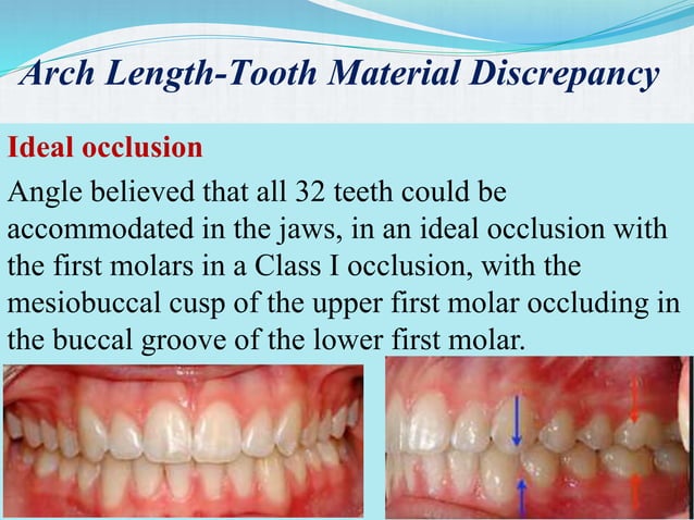 Extraction teeth for gaining space in orthodontics | PPT