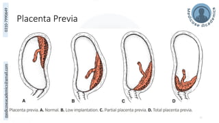 medicoseacademics@gmail.com
0310-7990649
Placenta Previa
32
 